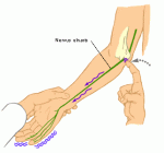Fig1_ulnar_nerve_compression