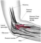 tennis-elbow-21
