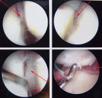 wrist-arthroscopy-pictures1