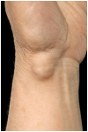 palmar-ganglion-cyst-of-the-wrist